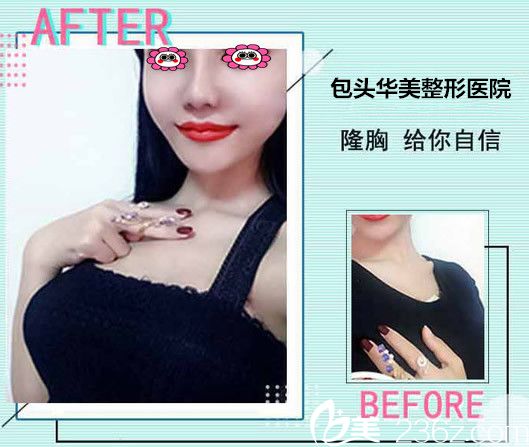 華美王金紅隆胸效果圖