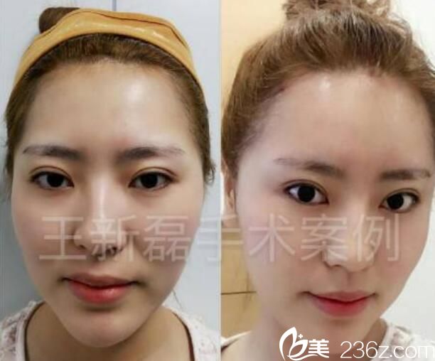 王新磊自體脂肪全臉填充案例前后效果對比圖