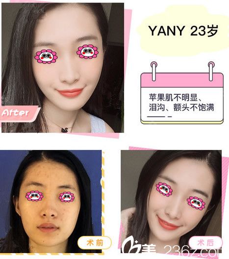 嘉興曙光整形白云亮主任面部脂肪填充效果圖