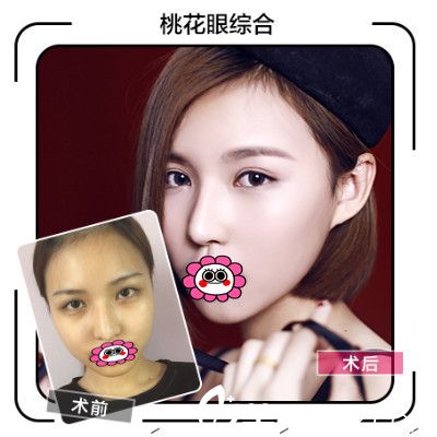 合肥華美朱德剛雙眼皮效果圖