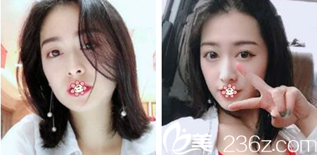 鄭潤(rùn)載雙眼皮術(shù)后2個(gè)月