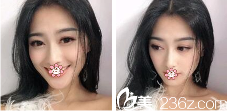 之前我想不通這個(gè)韓國(guó)夏娃eve整形外科沒(méi)啥包裝還挺火，鄭潤(rùn)載給我做完雙眼皮才知道為什么。