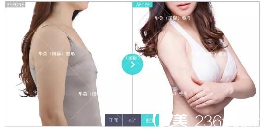 淮安華美高學(xué)龍醫(yī)生分享多個案例：SAC超活自體脂肪細(xì)胞填充不只是豐胸還能改善面部衰老