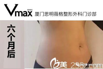 腹腰環(huán)吸六個月的恢復(fù)效果 腹腰環(huán)吸六個月的恢復(fù)效果