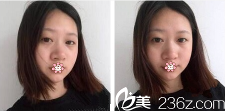 手術(shù)前的我 手術(shù)前的我