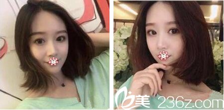 泰國(guó)然禧Yanhee整形醫(yī)院做雙眼皮怎么樣 泰國(guó)然禧Yanhee整形醫(yī)院做雙眼皮怎么樣