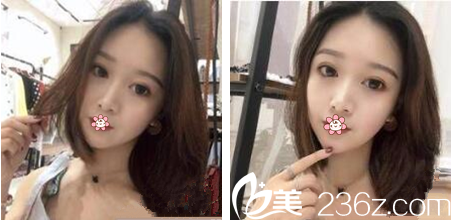 泰國(guó)然禧Yanhee整形隆鼻技術(shù)好不好 泰國(guó)然禧Yanhee整形隆鼻技術(shù)好不好