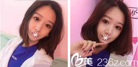 在泰國然禧Yanhee整形醫(yī)院做了雙眼皮和假體隆鼻后我才知道他們不是光做變性手術的。