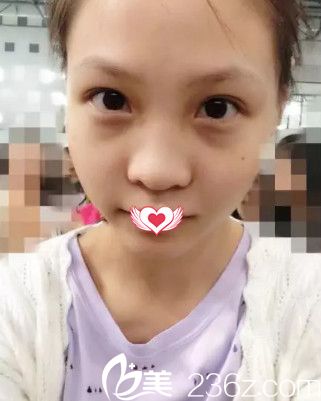 在藍(lán)山做鼻綜合術(shù)后鼻子塌平 在藍(lán)山做鼻綜合術(shù)后鼻子塌平