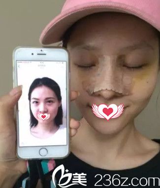 盧闖醫(yī)生為我剛做完鼻綜合術(shù)后擁有高挺鼻 盧闖醫(yī)生為我剛做完鼻綜合術(shù)后擁有高挺鼻