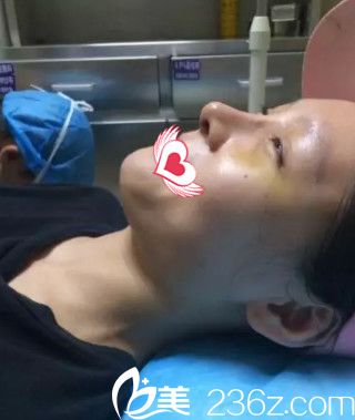 盧闖醫(yī)生為我做鼻綜合術(shù)后7天拆線(xiàn)后鼻子微腫 盧闖醫(yī)生為我做鼻綜合術(shù)后7天拆線(xiàn)后鼻子微腫