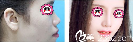 深圳富華鼻綜合手術(shù)真人案例效果