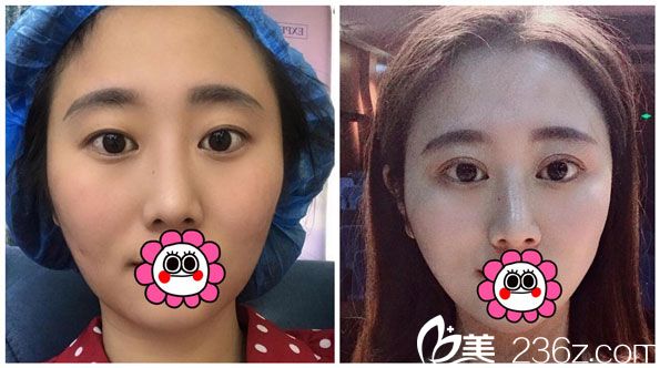 肖育亮眼綜合+全切雙眼皮效果對比圖