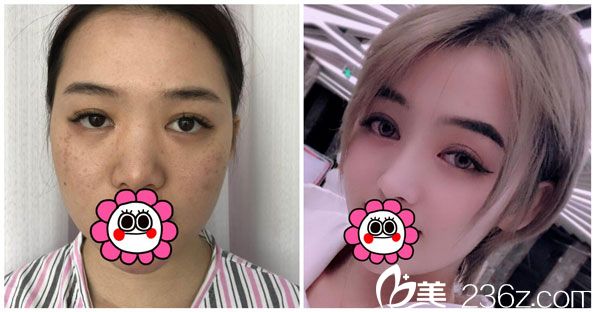 王德寧假體隆鼻+激光祛斑效果案例