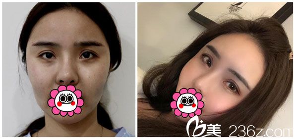 胡喬自體脂肪全臉填充效果對比圖