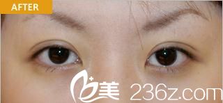 日本哪個醫(yī)院做切開法雙眼皮自然?赤井醫(yī)院赤井秀實給我做出的效果竟然是這樣的