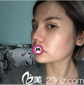 陳林葉給我做眼綜合第10天效果