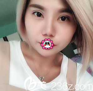 北京雅靚眼綜合案例