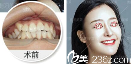 貴陽美萊整形牙齒正畸案例