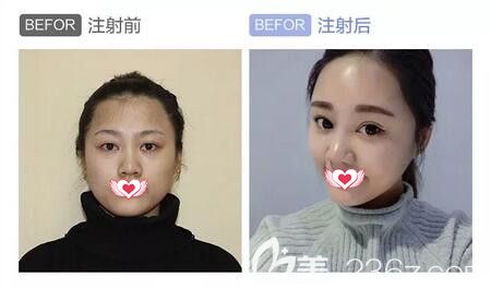 注射瑞藍(lán)2號(hào)玻尿酸填充太陽(yáng)穴、蘋(píng)果肌真人前后對(duì)比