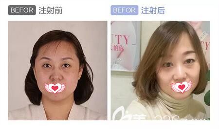 注射瑞藍(lán)2號(hào)玻尿酸填充面部及除皺真人前后效果對(duì)比