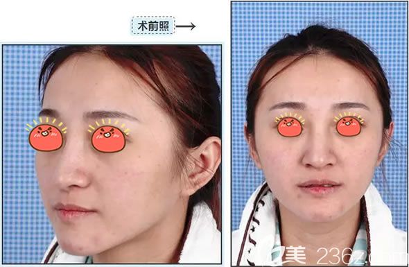 在義烏陽(yáng)光醫(yī)院做脂肪填充前 在義烏陽(yáng)光醫(yī)院做脂肪填充前