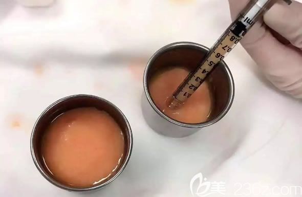 從腰腹部抽取的脂肪細(xì)胞 從腰腹部抽取的脂肪細(xì)胞