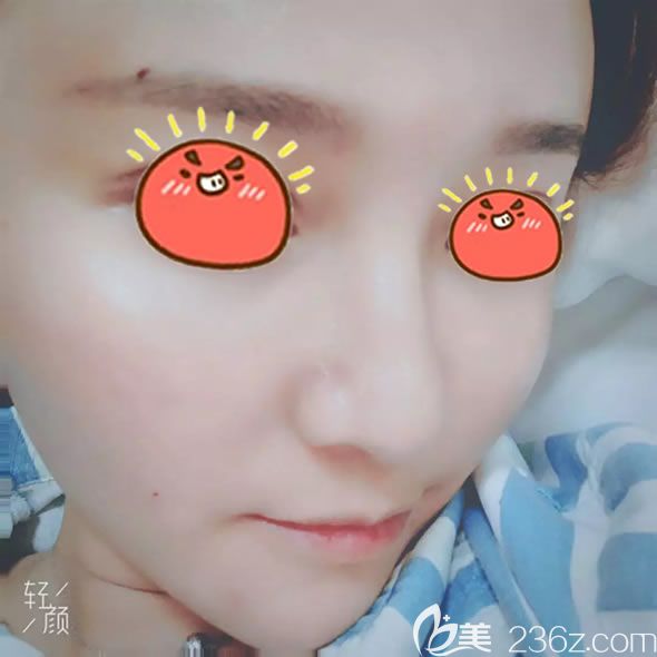 剛做完自體脂肪填充的照片 剛做完自體脂肪填充的照片