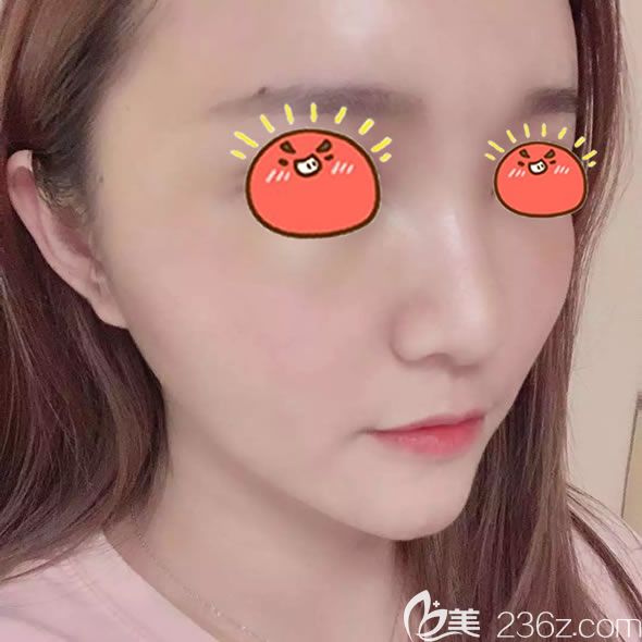 做完自體脂肪填充全臉7天恢復(fù)照 做完自體脂肪填充全臉7天恢復(fù)照