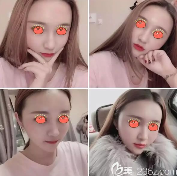 自體脂肪填充半個(gè)月<span style= 自體脂肪填充半個(gè)月<span style=