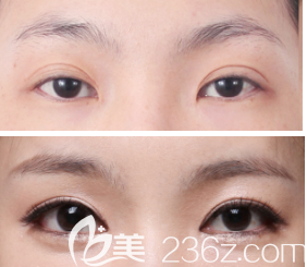 過寬雙眼皮改造案例