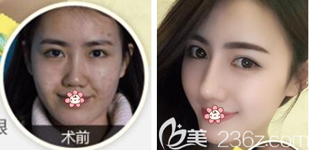 貴陽華美做雙眼皮隆鼻效果怎么樣