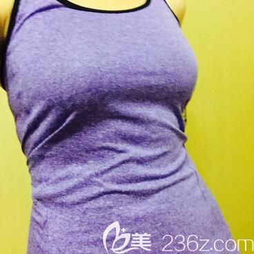 本人在太原歐美蓮整形做360環(huán)形腰腹部吸脂20天了，來(lái)分享親身經(jīng)歷及前后對(duì)比照