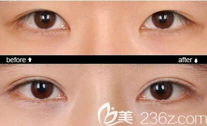 郭建醫(yī)生做韓式無(wú)痕雙眼皮術(shù)后效果對(duì)比