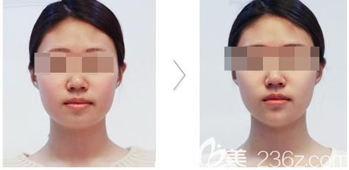 田雨注射瘦臉除皺案例 田雨注射瘦臉除皺案例