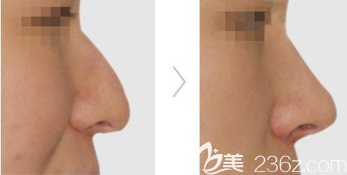 田雨鼻尖形成術(shù)案例 田雨鼻尖形成術(shù)案例