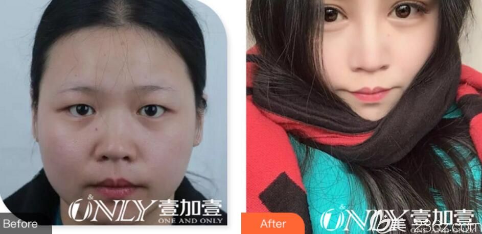 合肥壹加壹孟松雙眼皮案例