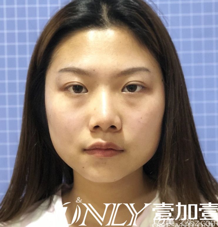 找合肥壹加壹孟松做面部吸脂術(shù)前照 找合肥壹加壹孟松做面部吸脂術(shù)前照