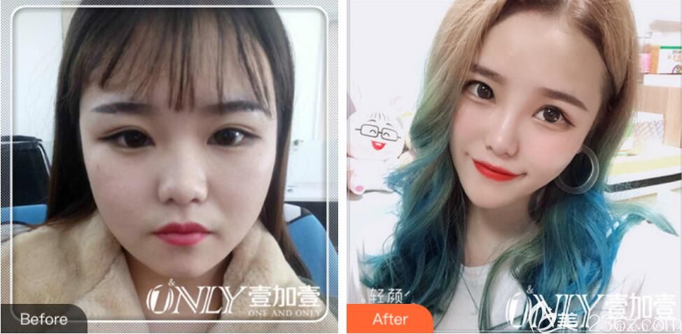 讓金王做艾莉薇玻尿酸隆鼻、下巴+進(jìn)口瘦臉案例效果對比圖