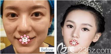 重慶鄭荃麗格線雕提升效果怎么樣