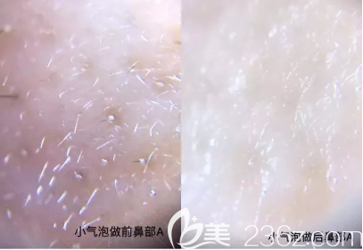 小氣泡清除毛孔殘留物