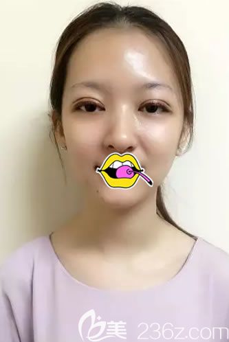 剛做完雙眼皮綜合手術(shù)照片