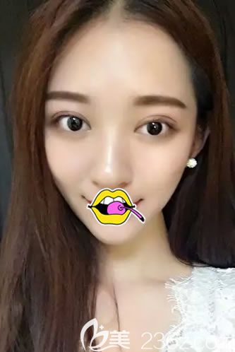 在<!--<i data=20240703-sp></i>-->做雙眼皮10天恢復(fù)照