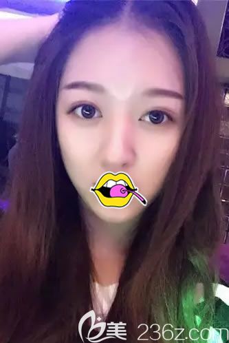 <!--<i data=20240703-sp></i>-->譚成林做雙眼皮30天效果