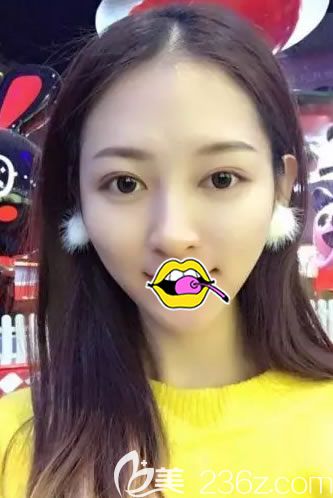 應(yīng)付過年的各種party,有我找譚成林院長做的雙眼皮大眼睛足矣