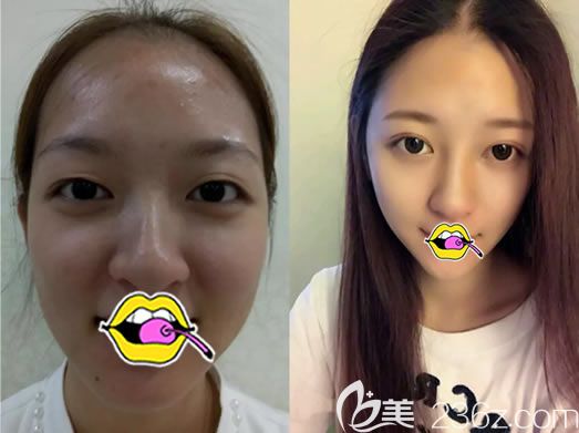 <!--<i data=20240703-sp></i>-->譚成林雙眼皮案例對比圖