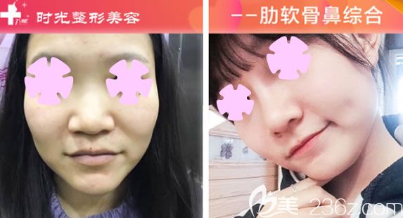 玉林時光整形鼻綜合案例效果