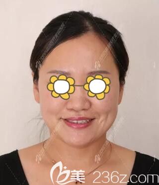 做完面部埋線提升術(shù)后半個月效果情況 做完面部埋線提升術(shù)后半個月效果情況