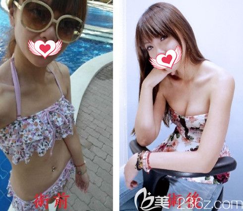 陳俊光院長做自體脂肪豐胸案例