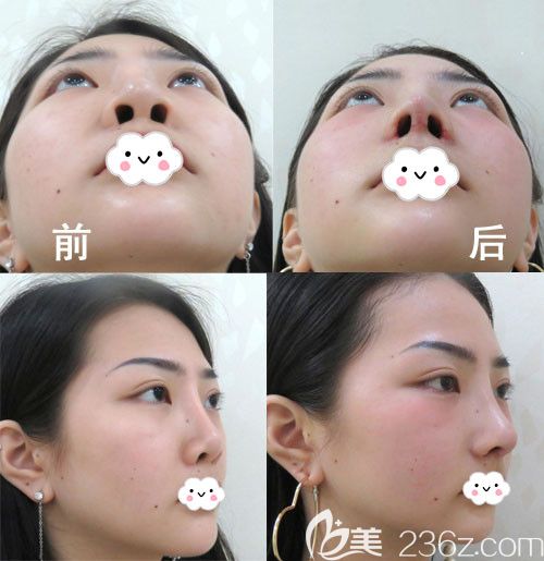武漢美立方隆鼻怎么樣？胡江偉鼻修復(fù)案例前后對(duì)比圖